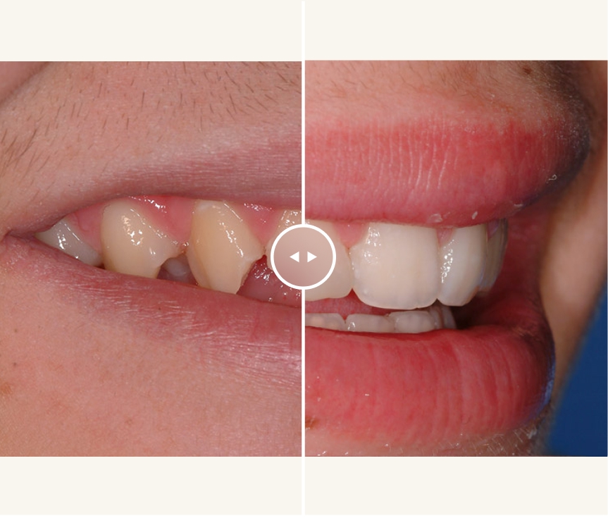 ANTES-DESPUES