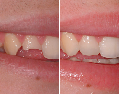 Reconstrucción dental