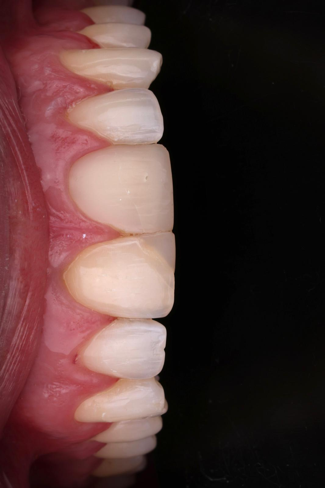 Estética dental caso 1 - Smilelife