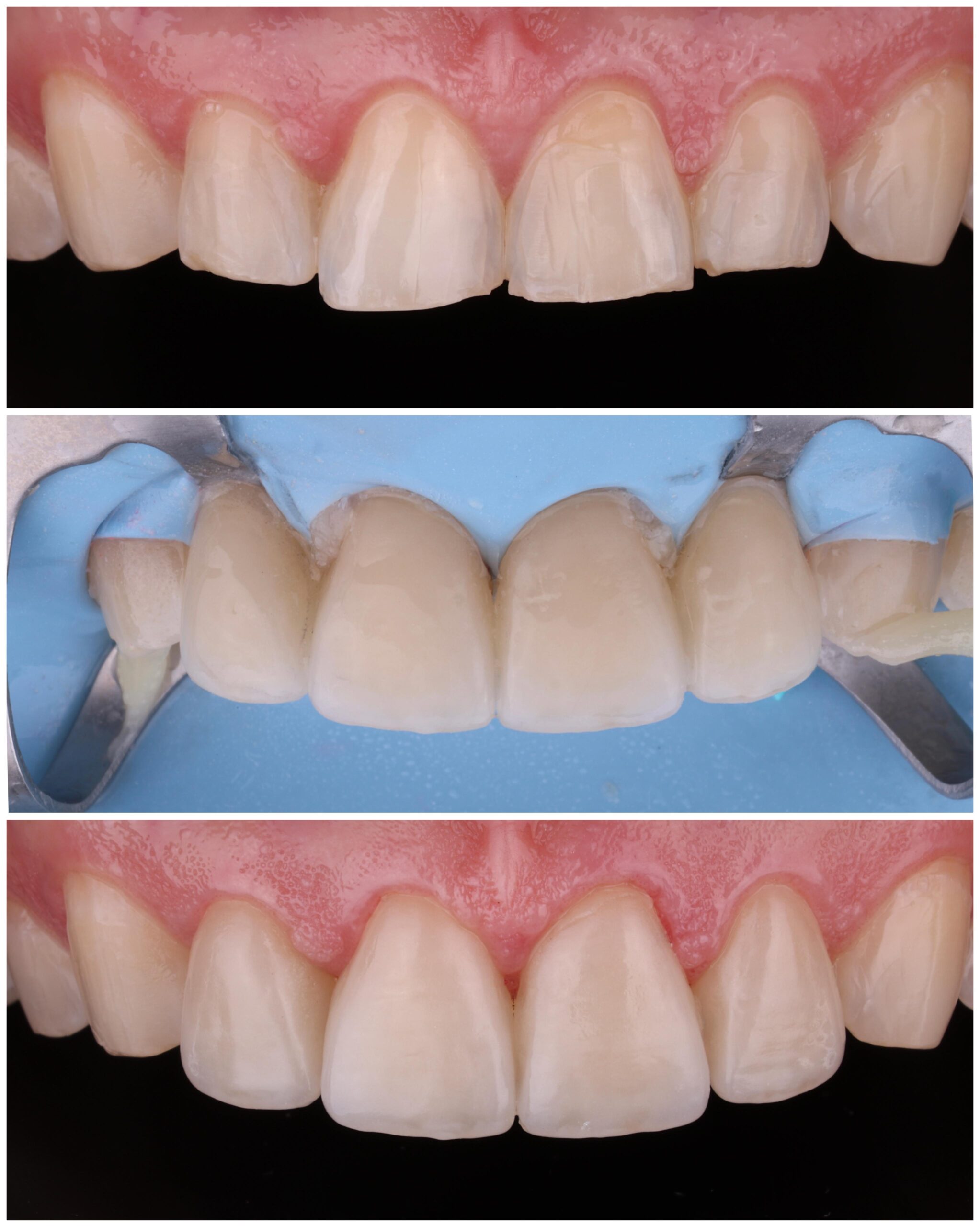 Estética dental caso 2 - Smilelife