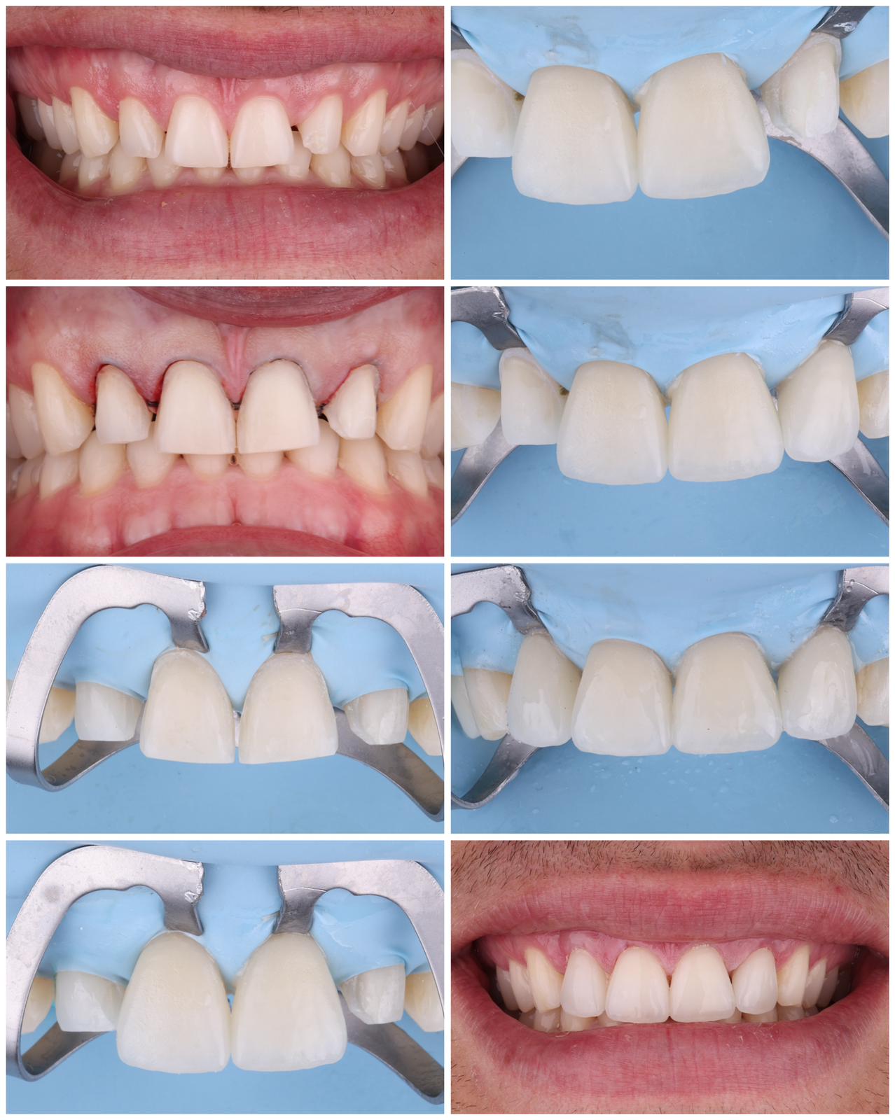 Tratamiento estético con carillas