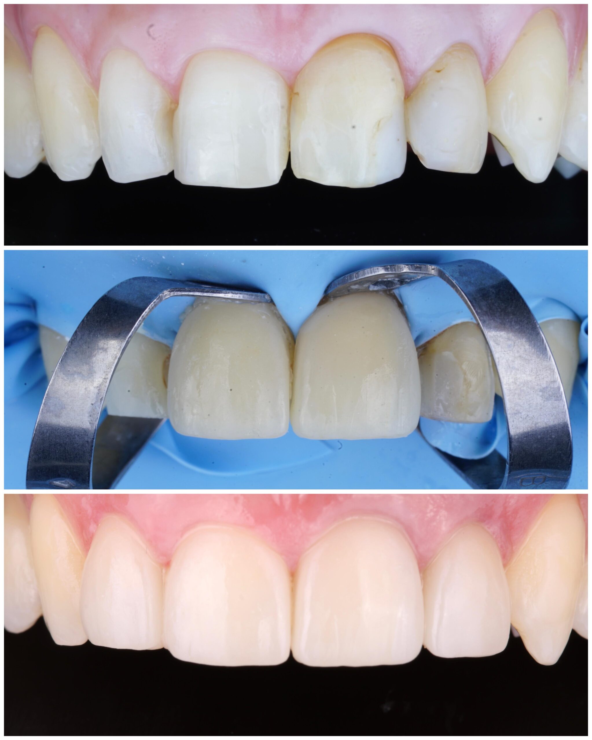 Diseño de sonrisa con carillas en Smilelife