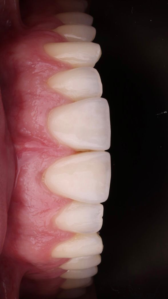 Sonrisa tras blanqueamiento dental