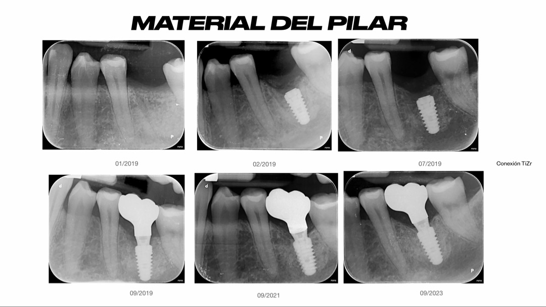 Seguimiento radiográfico de un implante dental con conexión TiZr de 2019 a 2023 sin pérdida ósea