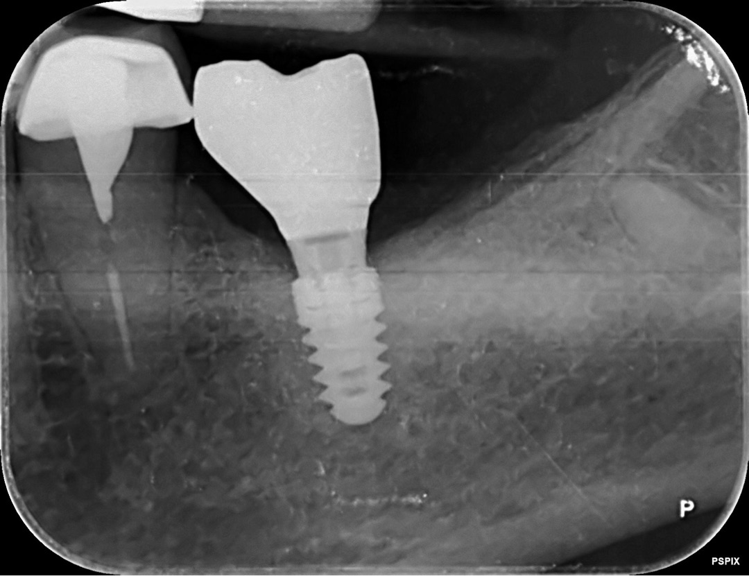 Radiografía de un implante dental con conexión cónica y corona atornillada
