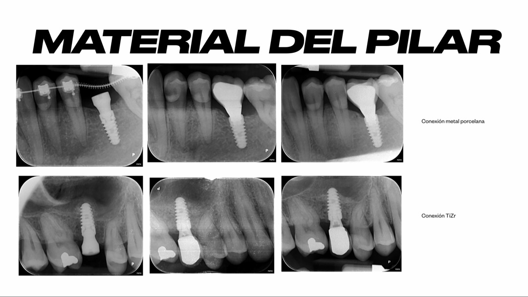 Comparativa radiográfica entre pilar metal-porcelana y pilar TiZr en implantes dentales