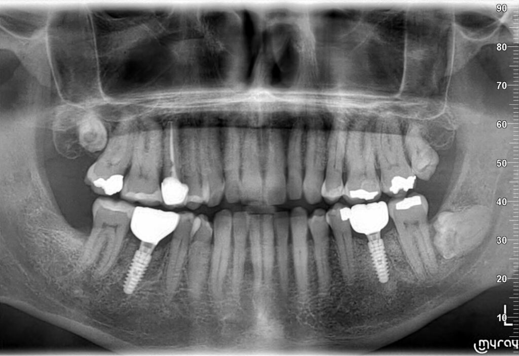 Radiografía panorámica con implantes dentales colocados en Smilelife Madrid y Fuenlabrada