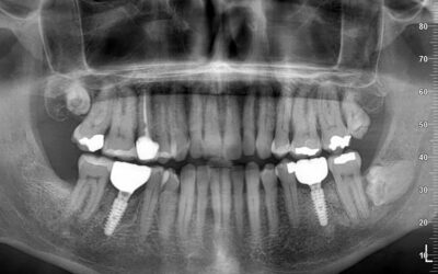 Radiografía panorámica con implantes dentales colocados en Smilelife Madrid y Fuenlabrada