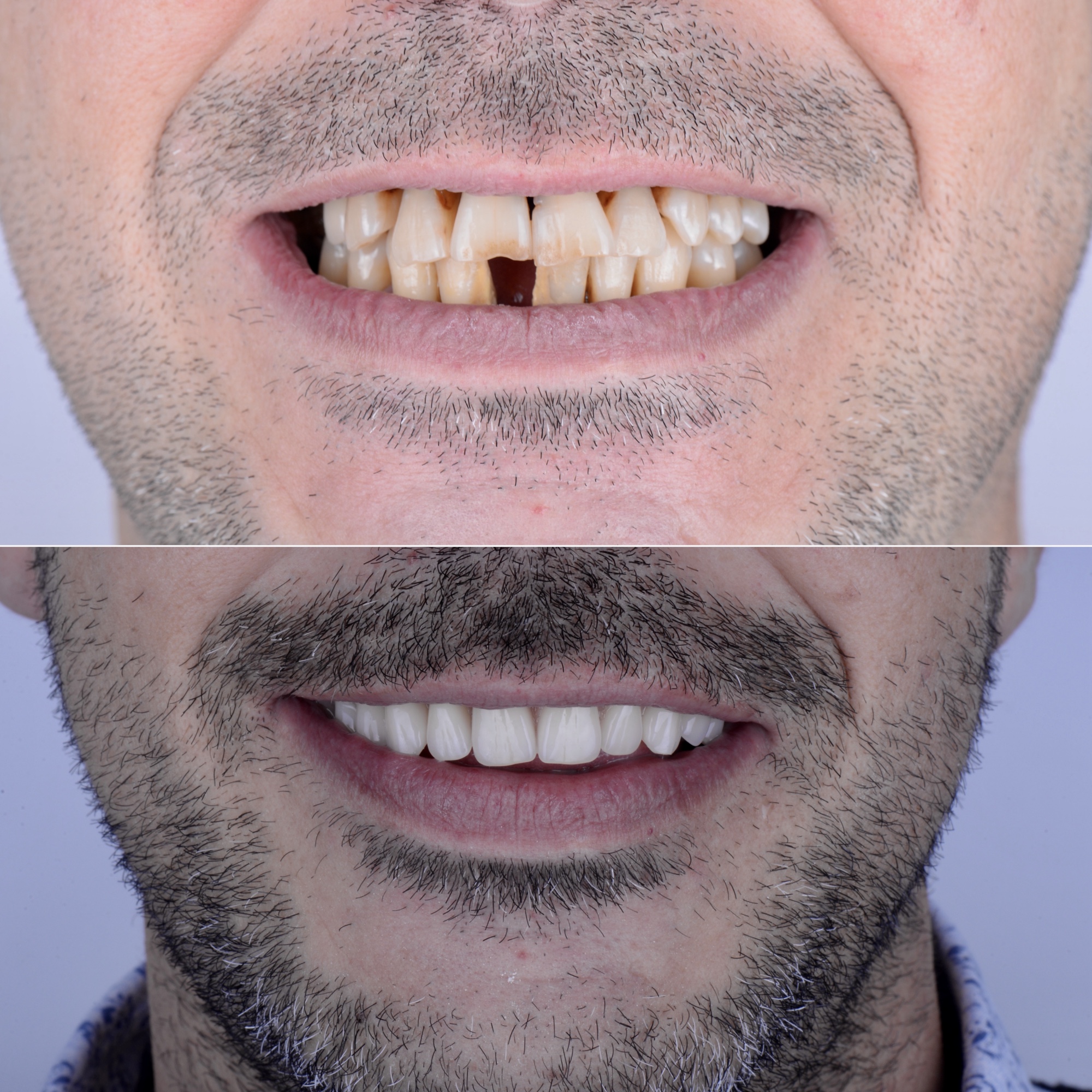 Caso real rehabilitación completa carga inmediata Smilelife Madrid