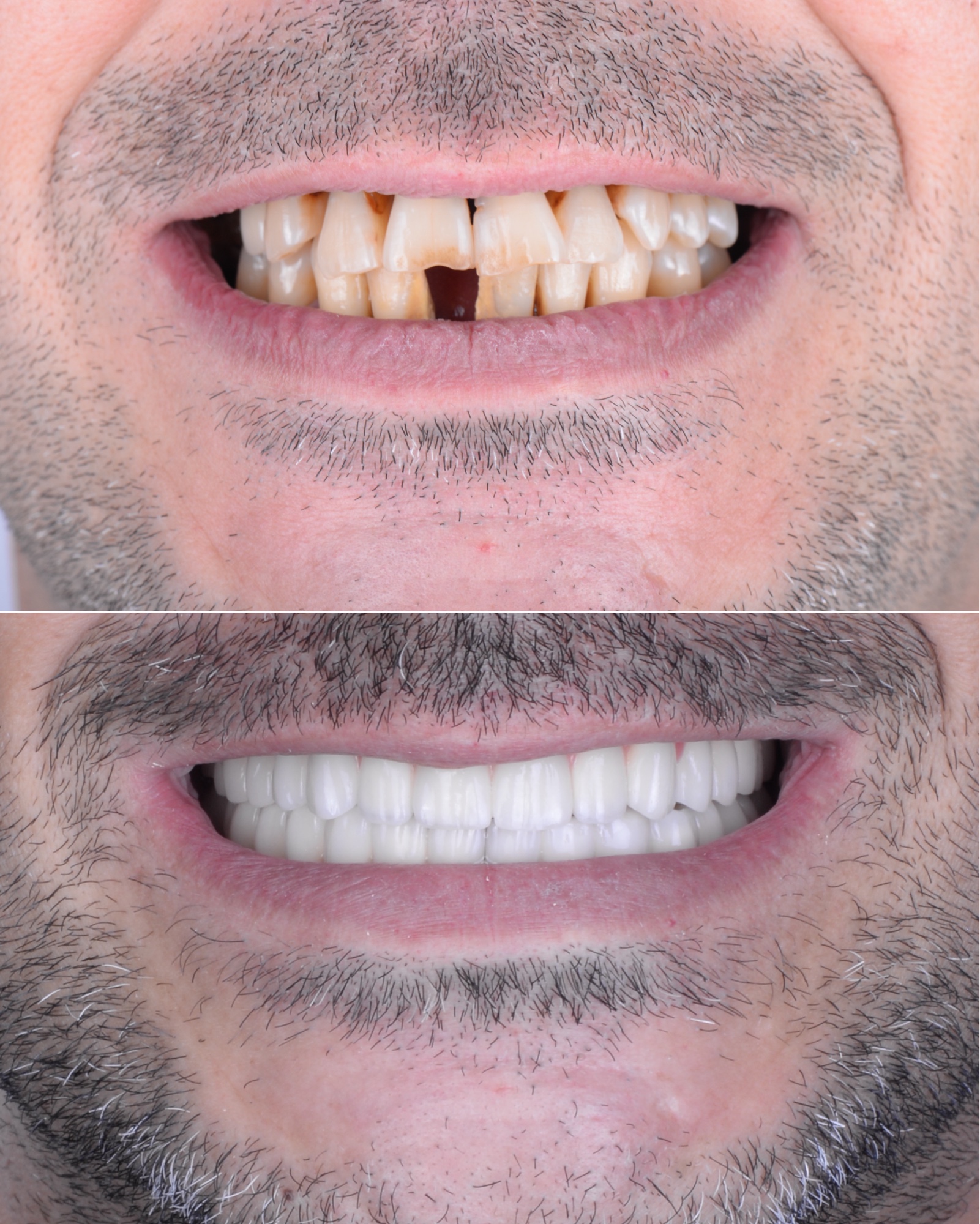 Resultado prótesis definitiva carga inmediata Smilelife Madrid