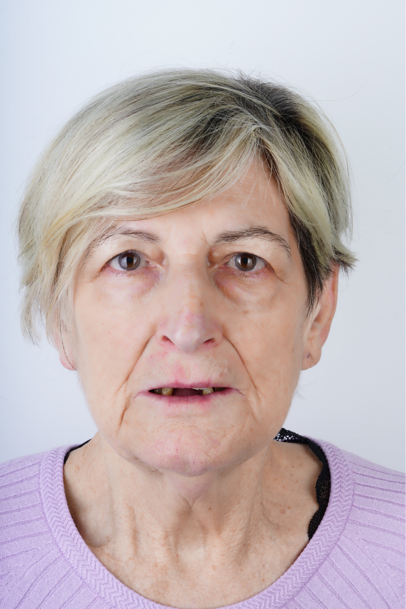 sobredentadura sobre implantes Locator Smilelife Madrid - estado inicial periodontitis