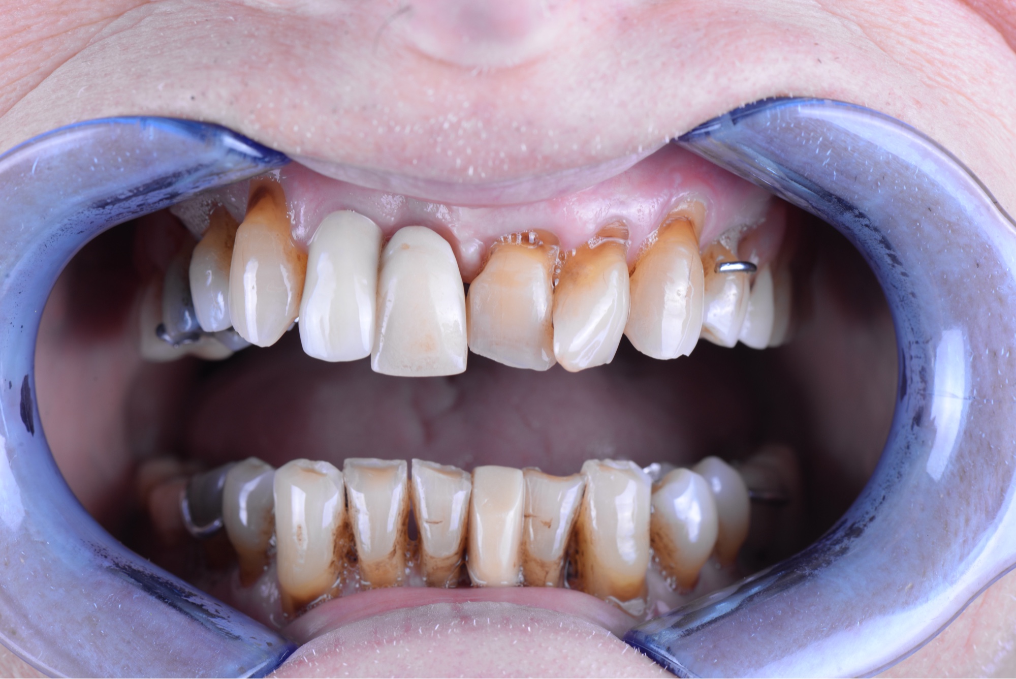 Caso real antes rehabilitación con 6 implantes superior y coronas inferior Smilelife Madrid