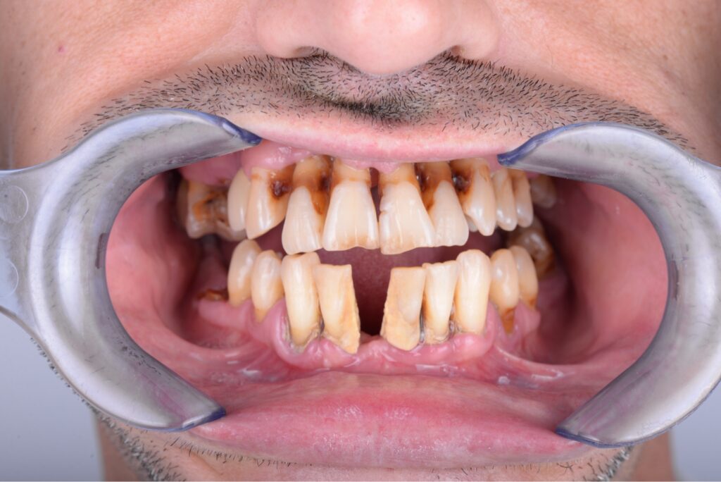 Antes rehabilitación completa con implantes Smilelife Madrid