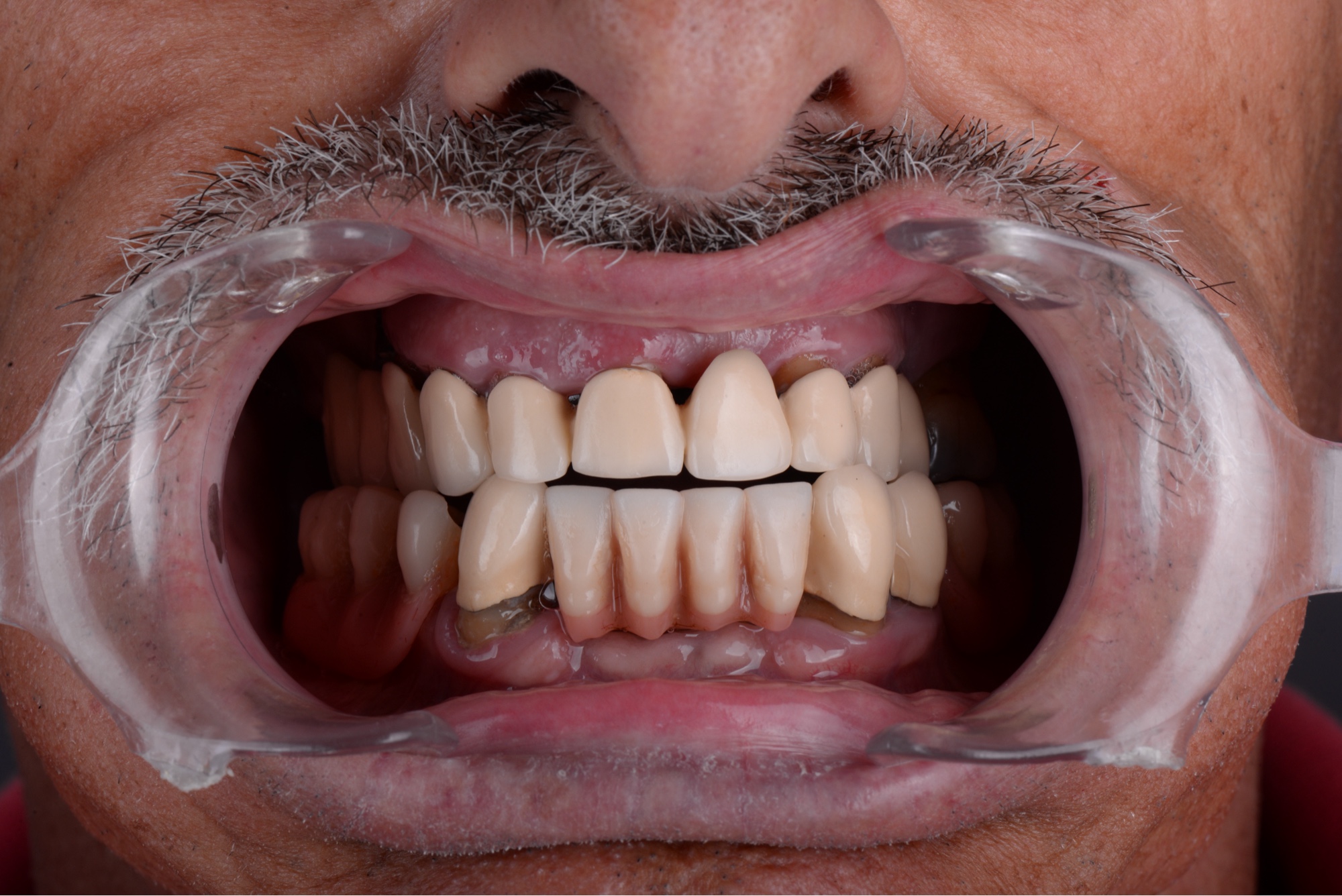 Detalle intraoral de la prótesis provisional acrílica sobre 6 implantes con carga inmediata — Smilelife Madrid