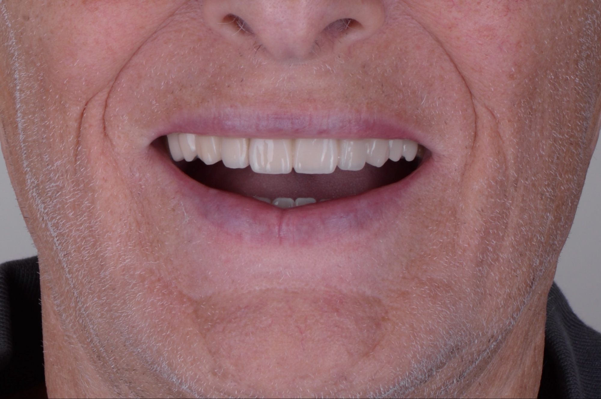Caso real después rehabilitación con 6 implantes superior y coronas inferior Smilelife Madrid
