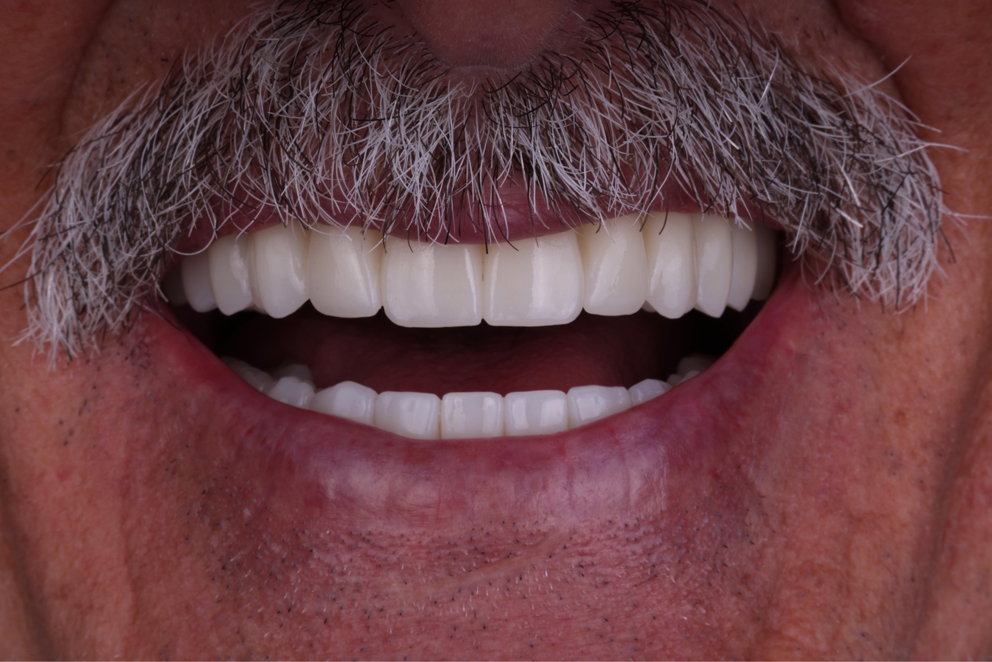 Detalle intraoral de prótesis definitiva en zirconio sobre barra de titanio en 6 implantes superiores — Smilelife Madrid