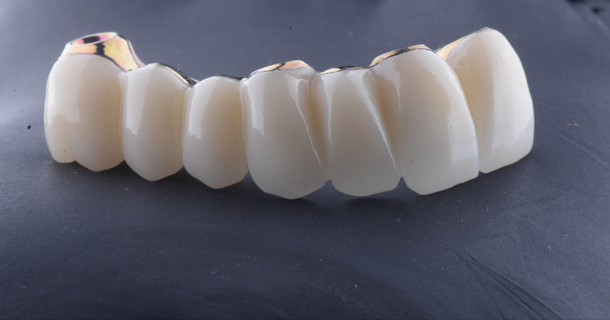 Protesis sobre implantes zirconio vista frontal Smilelife Madrid