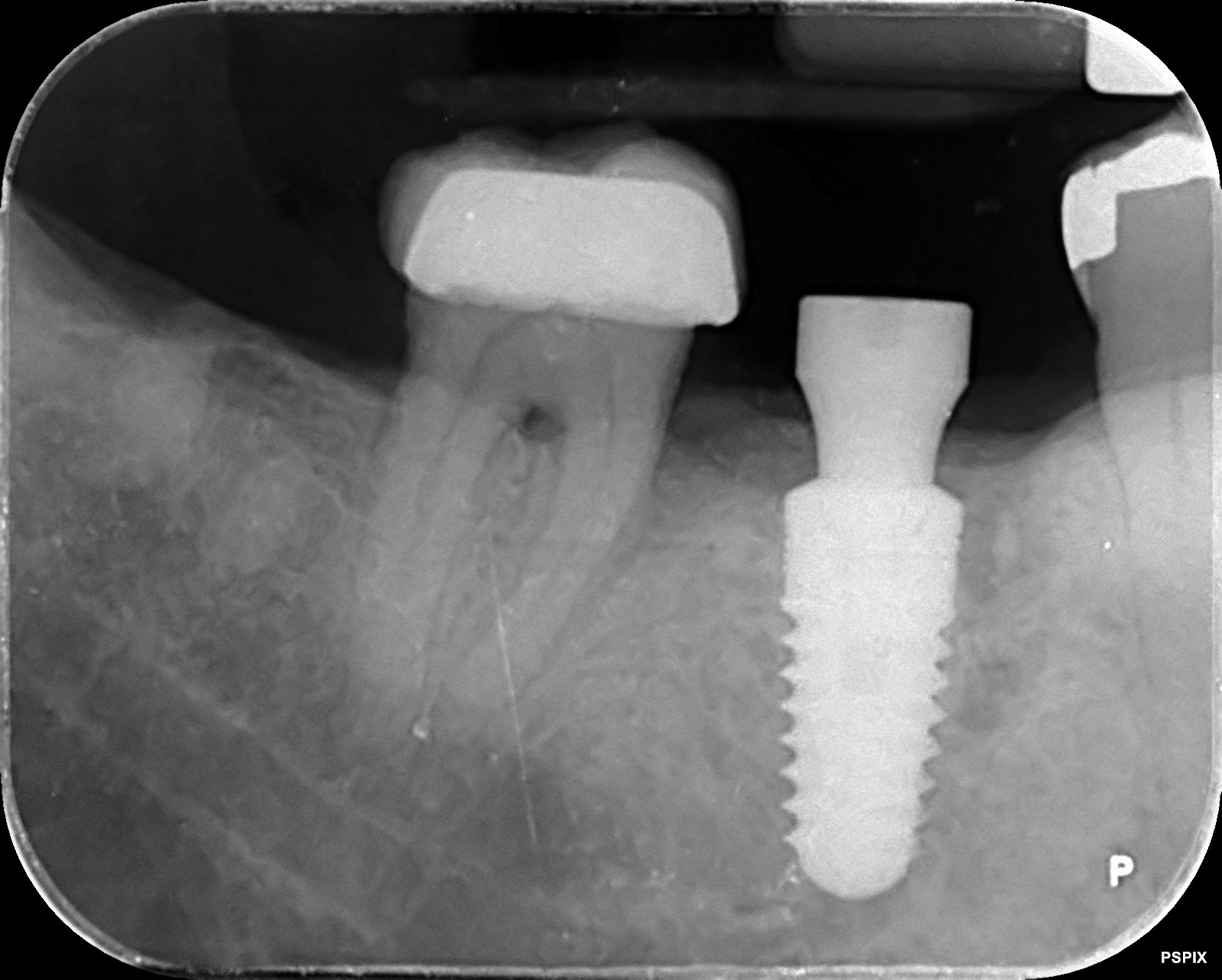 Radiografia implante dental nuevo colocado despues Smilelife Madrid