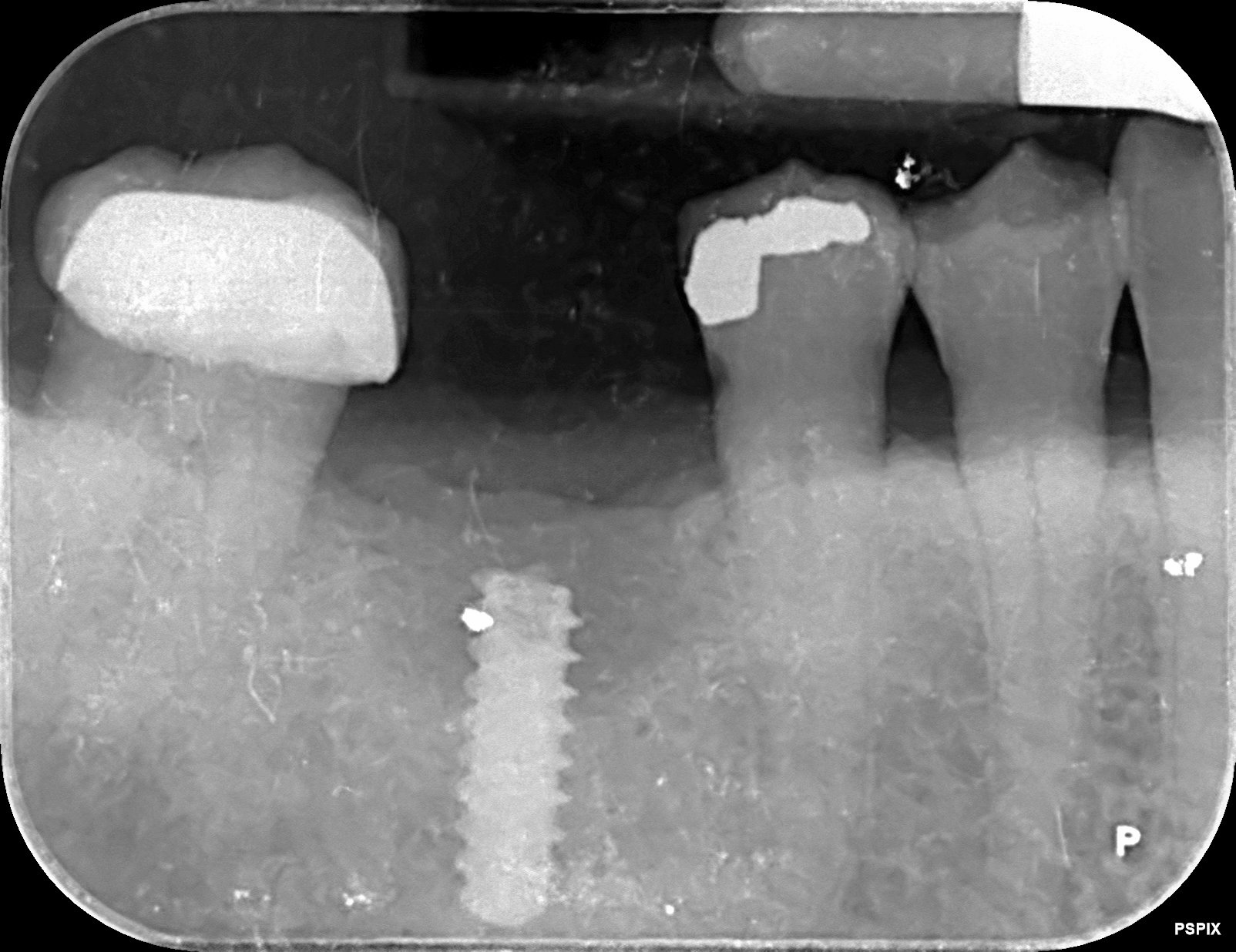 Radiografia implante dental fracturado antes Smilelife Madrid
