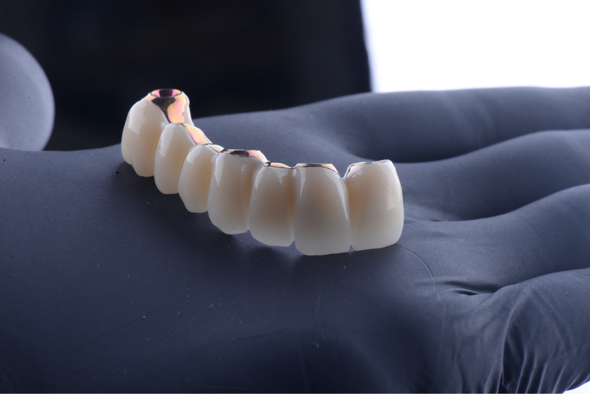 Rehabilitacion sobre implantes con estructura titanio y zirconio Smilelife Madrid