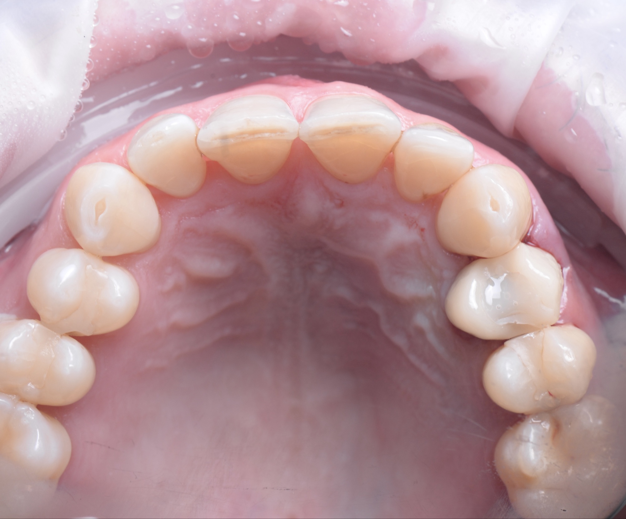 Resultado de carga inmediata sobre implantes el mismo día — Smilelife Madrid