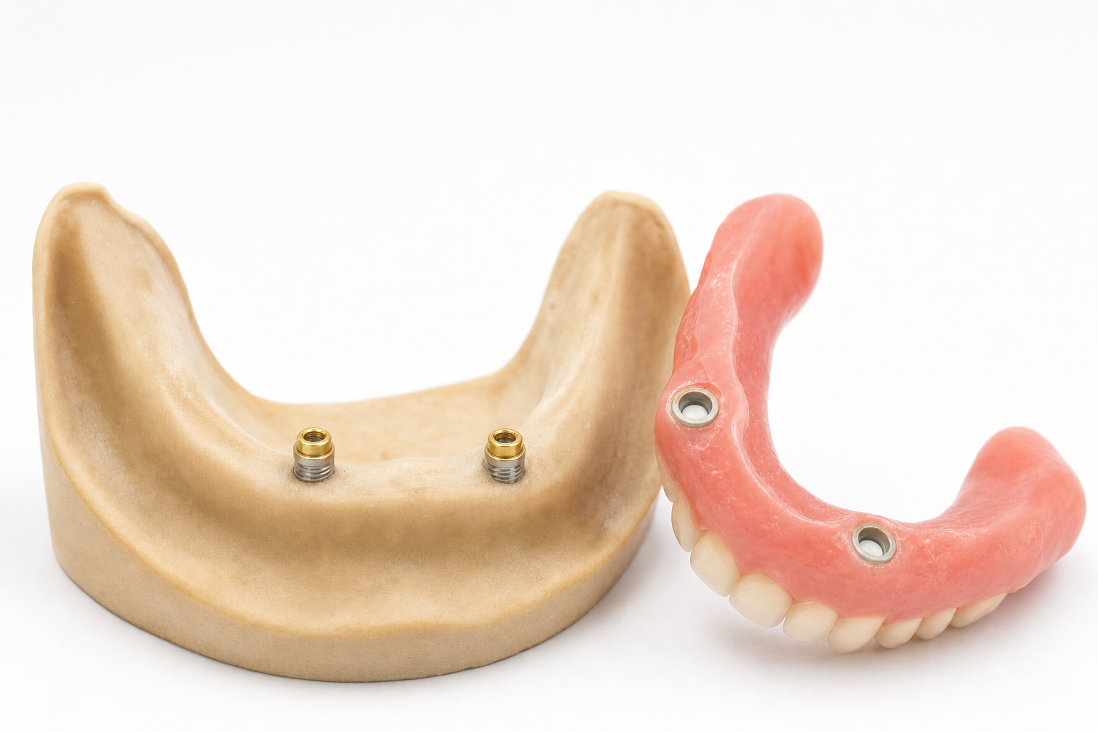 sobredentadura sobre implantes con Locator Smilelife Madrid - modelo dental