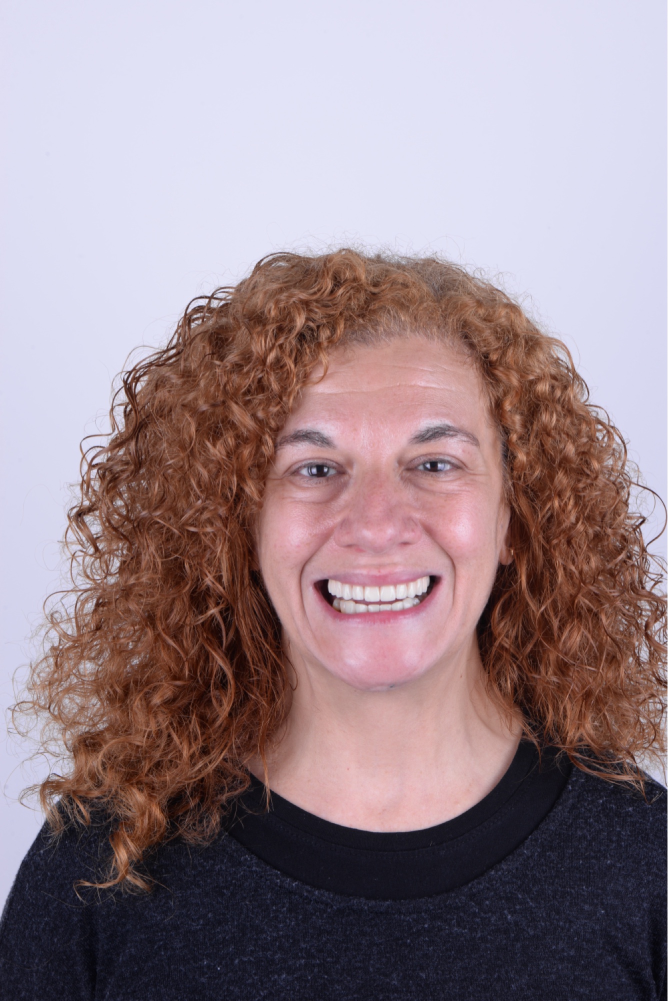 Caso real implantes carillas Smilelife Madrid