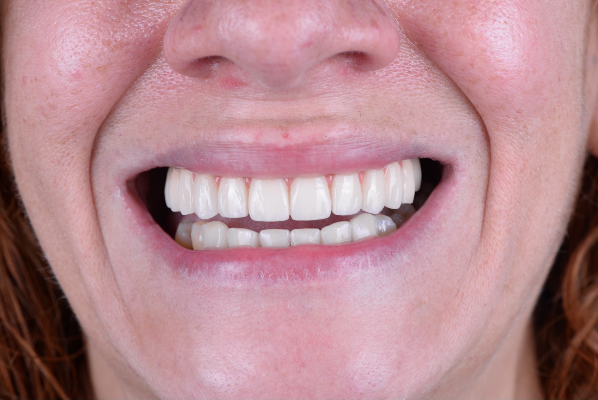 Resultado rehabilitación implantes carillas Smilelife Madrid