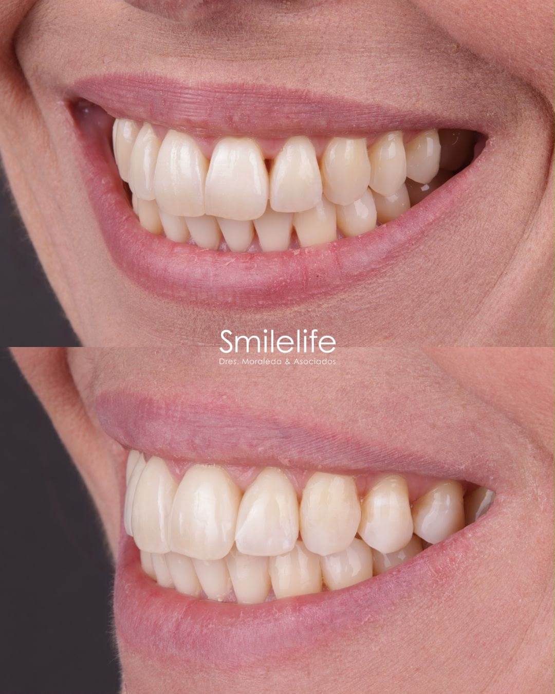 Antes y después de cierre de troneras con composite - vista frontal - Smilelife Madrid