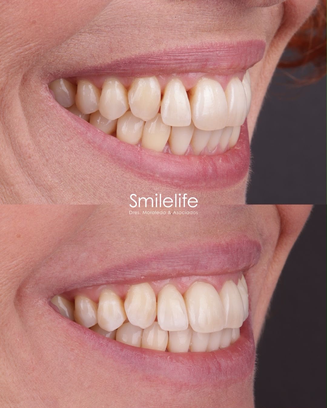 Cierre de troneras con composite - vista lateral - Smilelife