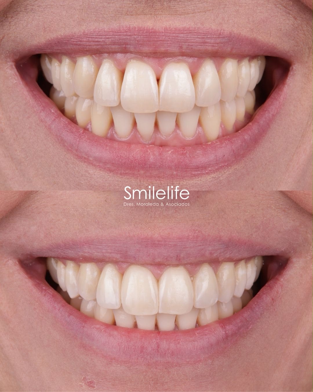 Cierre de troneras con composite antes y después primer plano - Smilelife Madrid
