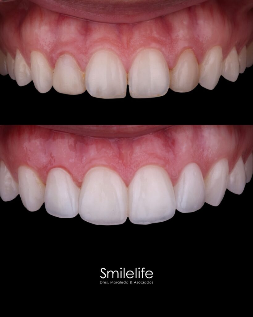 diseño de sonrisa con carillas Smilelife Madrid — caso real antes y después